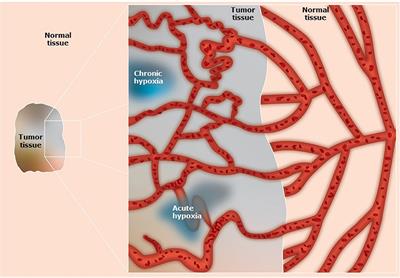 Tumor Hypoxia: Impact on Radiation Therapy and Molecular Pathways